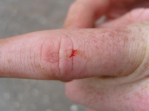 Injured finger