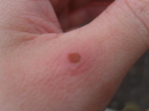 Blister